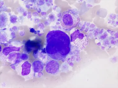 Cancer : les inégalités sociales creusent l'écart face à la maladie