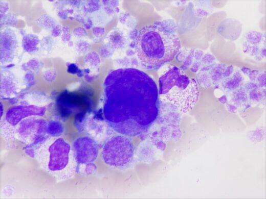 Cancer : les inégalités sociales creusent l'écart face à la maladie